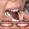 Dentier Amovible Réutilisable